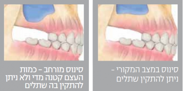 הסוף לשטפי דם וכאבים בביצוע שתלים / ד"ר שגב ברטי