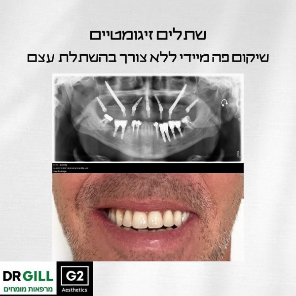 שתלים זיגומטיים בשיקום מידי של לסת עליונה